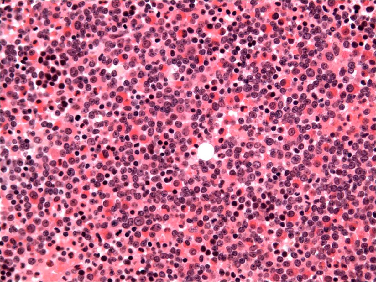 Bone marrow biopsy, 20X